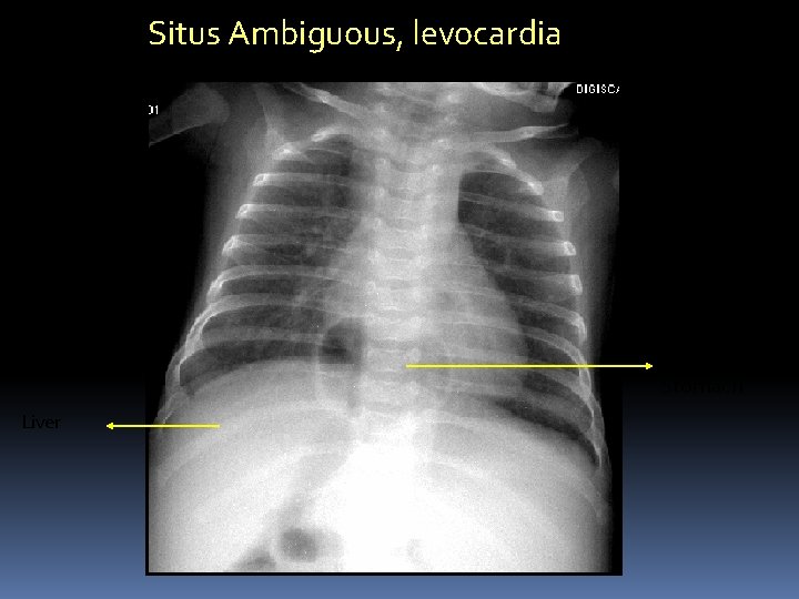 Situs Ambiguous, levocardia Mid line Stomach Liver 