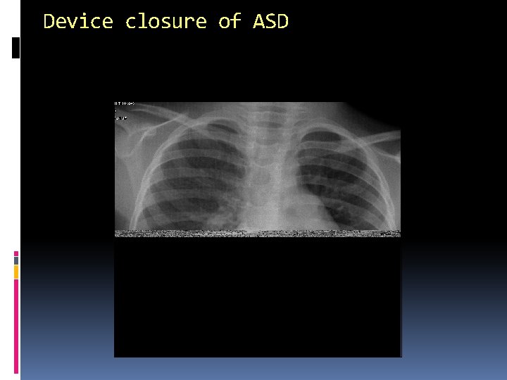 Device closure of ASD 