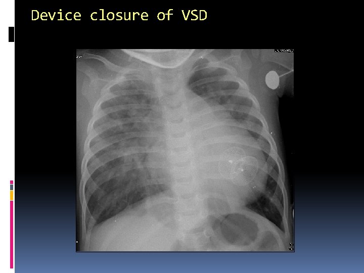 Device closure of VSD 