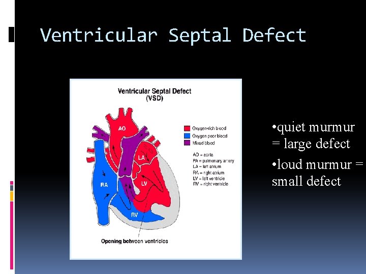 Ventricular Septal Defect • quiet murmur = large defect • loud murmur = small