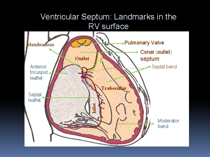 Ventricular Septum: Landmarks in the RV surface Pulmonary Valve Membranous Conal (outlet) Outlet septum