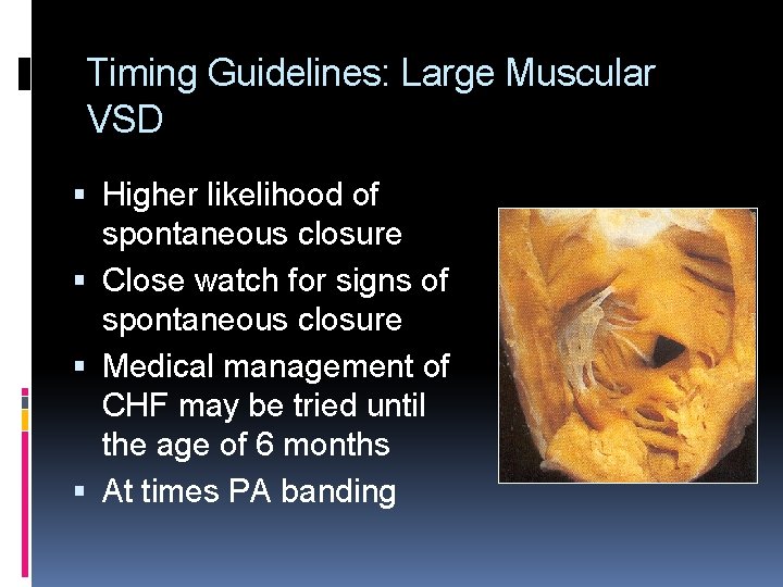 Timing Guidelines: Large Muscular VSD Higher likelihood of spontaneous closure Close watch for signs