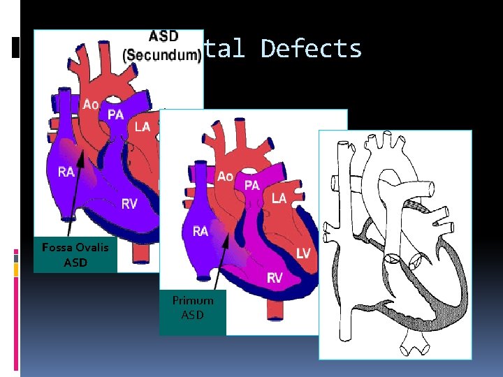 Atrial Septal Defects Fossa Ovalis ASD Primum ASD 