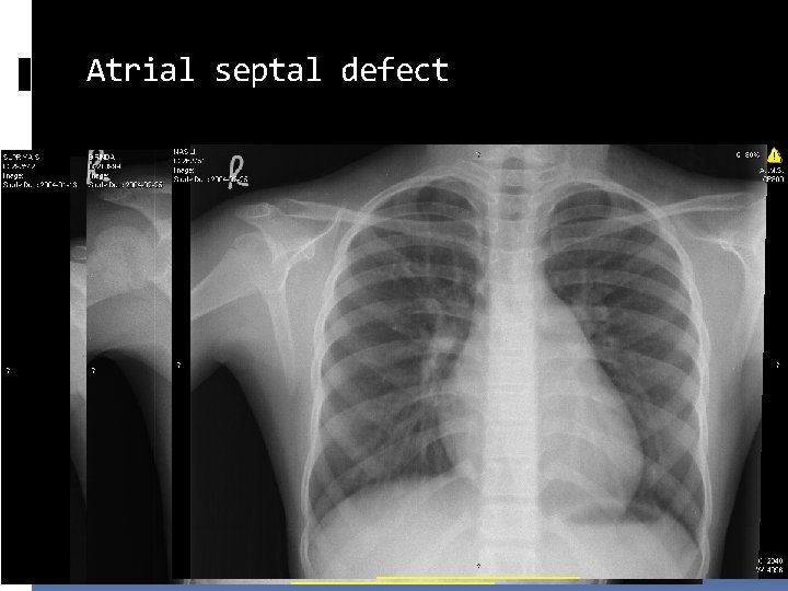 Atrial septal defect 