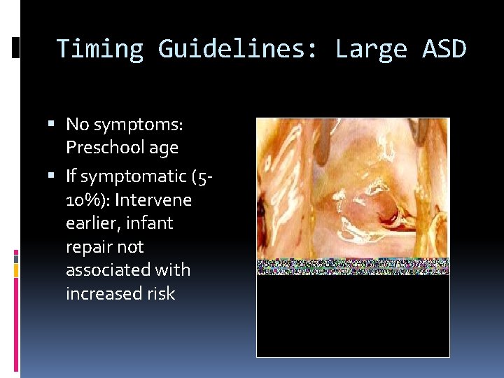 Timing Guidelines: Large ASD No symptoms: Preschool age If symptomatic (510%): Intervene earlier, infant