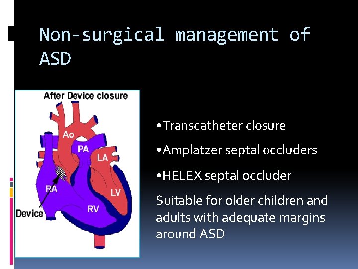 Non-surgical management of ASD • Transcatheter closure • Amplatzer septal occluders • HELEX septal