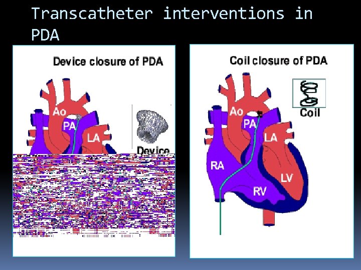 Transcatheter interventions in PDA 