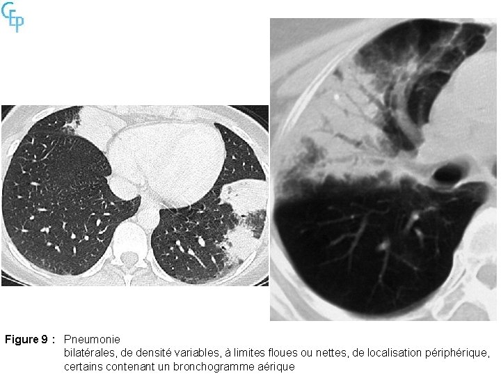 Figure 9 : Pneumonie bilatérales, de densité variables, à limites floues ou nettes, de