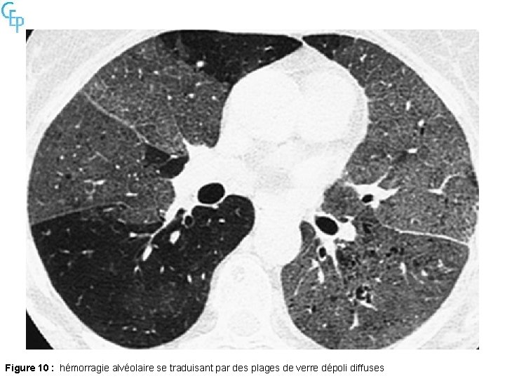 Figure 10 : hémorragie alvéolaire se traduisant par des plages de verre dépoli diffuses