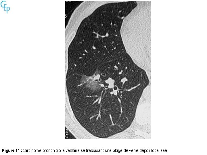 Figure 11 : carcinome bronchiolo-alvéolaire se traduisant une plage de verre dépoli localisée 