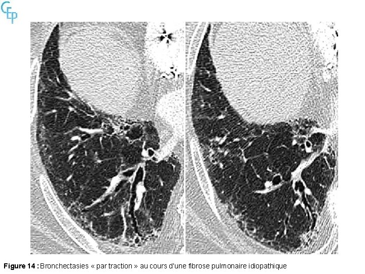 Figure 14 : Bronchectasies « par traction » au cours d’une fibrose pulmonaire idiopathique