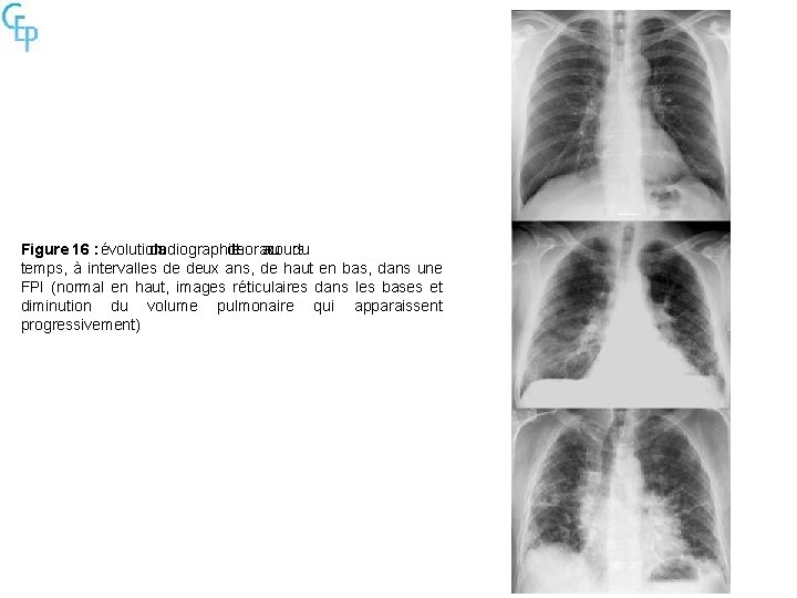 Figure 16 : évolution de radiographie la de thorax au cours du temps, à