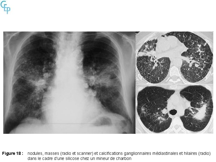 Figure 18 : nodules, masses (radio et scanner) et calcifications ganglionnaires médiastinales et hilaires