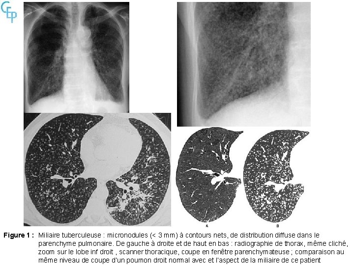 Figure 1 : Miliaire tuberculeuse : micronodules (< 3 mm) à contours nets, de