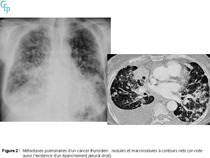 Figure 2 : Métastases pulmonaires d’un cancer thyroïdien : nodules et macronodules à contours