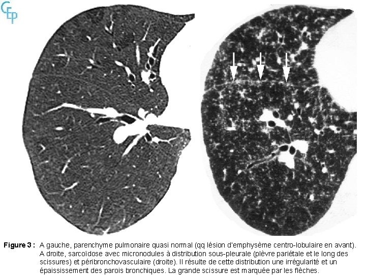 Figure 3 : A gauche, parenchyme pulmonaire quasi normal (qq lésion d’emphysème centro-lobulaire en