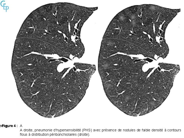 e uche, Figure 4 : A A droite, pneumonie d’hypersensibilité (PHS) avec présence de