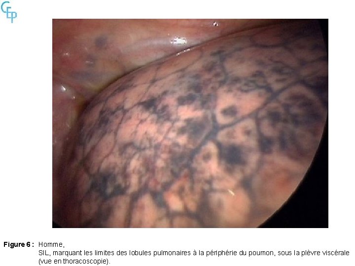 Figure 6 : Homme, SIL, marquant les limites des lobules pulmonaires à la périphérie