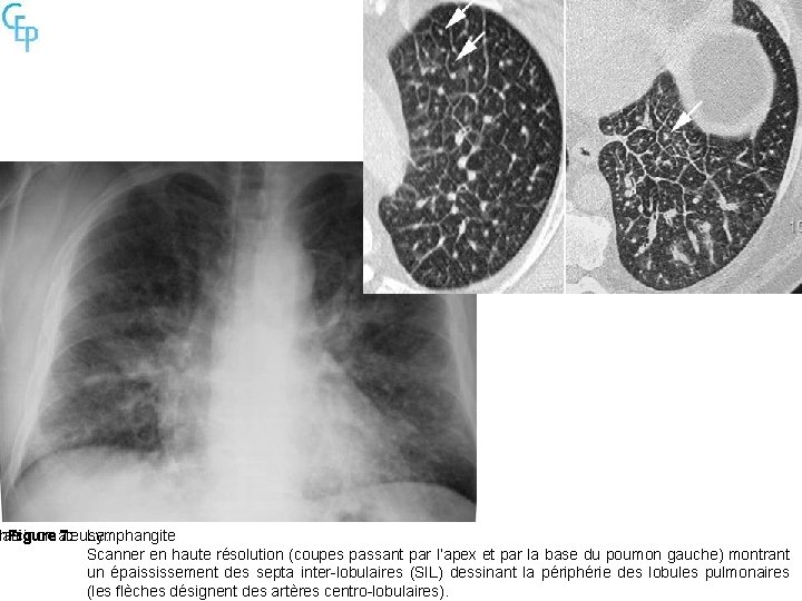 carcinomateuse. hie Figure 7: Lymphangite Scanner en haute résolution (coupes passant par l’apex et