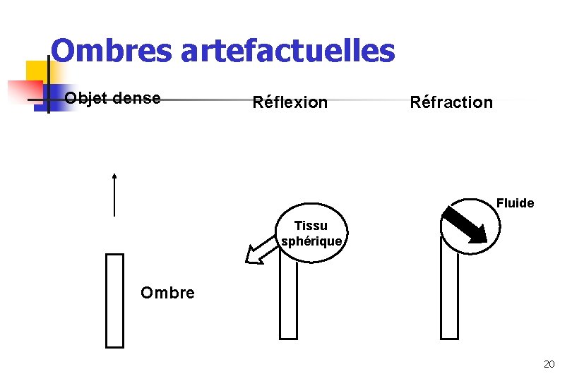 Ombres artefactuelles Objet dense Réflexion Réfraction Fluide Tissu sphérique Os Ombre 20 