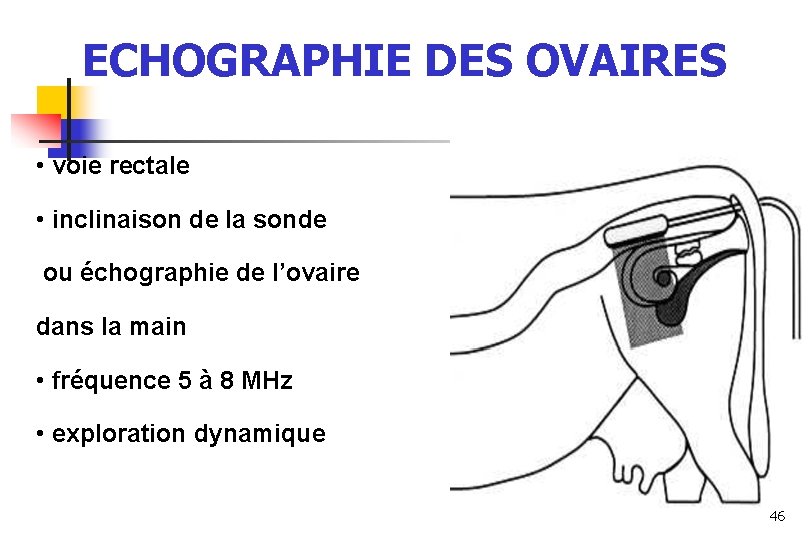 ECHOGRAPHIE DES OVAIRES • voie rectale • inclinaison de la sonde ou échographie de ECHOGRAPHIE DES OVAIRES • voie rectale • inclinaison de la sonde ou échographie de