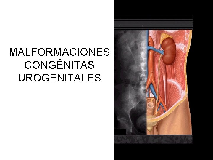 MALFORMACIONES CONGÉNITAS UROGENITALES 