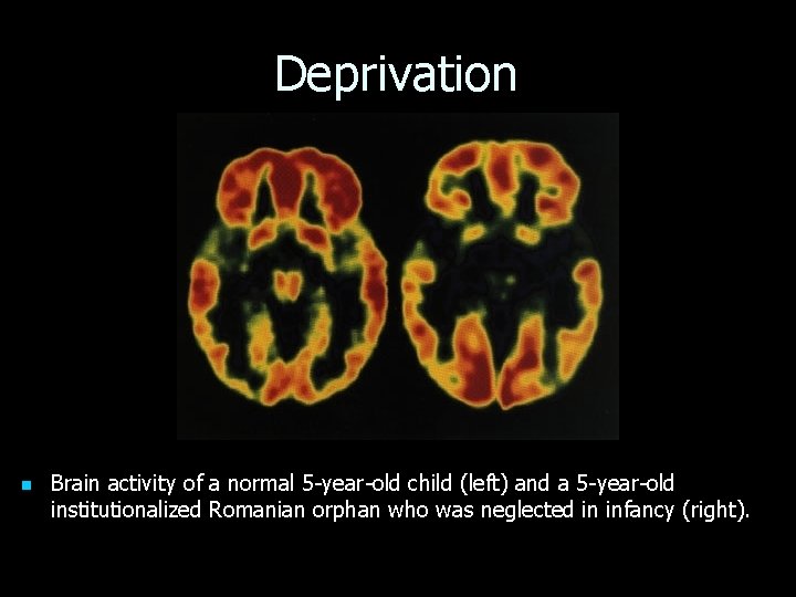 Deprivation n Brain activity of a normal 5 -year-old child (left) and a 5