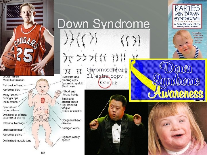 Down Syndrome Chromosome 21 -extra copy 