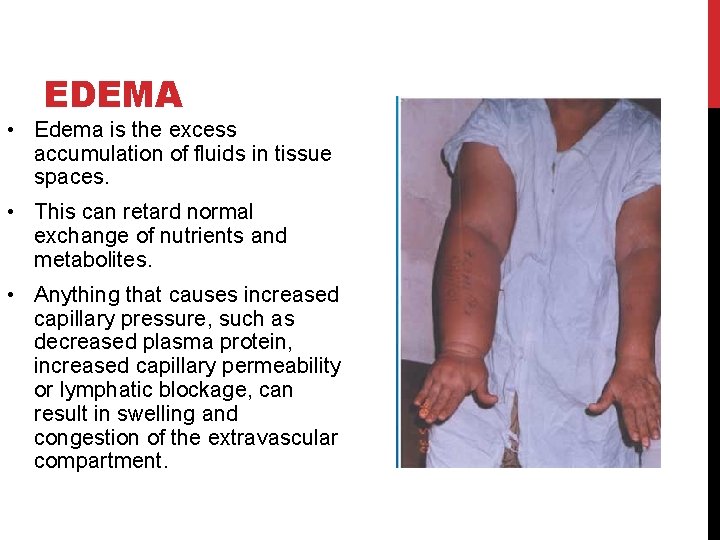 EDEMA • Edema is the excess accumulation of fluids in tissue spaces. • This