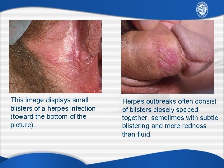 This image displays small blisters of a herpes infection (toward the bottom of the