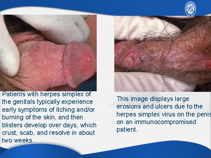 Patients with herpes simplex of the genitals typically experience early symptoms of itching and/or