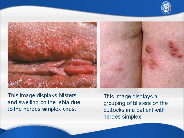 This image displays blisters and swelling on the labia due to the herpes simplex