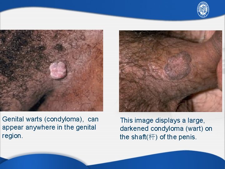 Genital warts (condyloma), can appear anywhere in the genital region. This image displays a