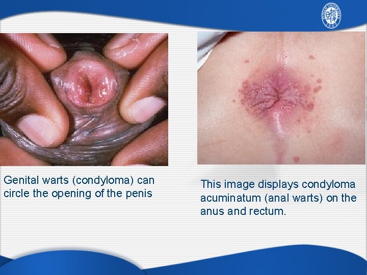 Genital warts (condyloma) can circle the opening of the penis This image displays condyloma