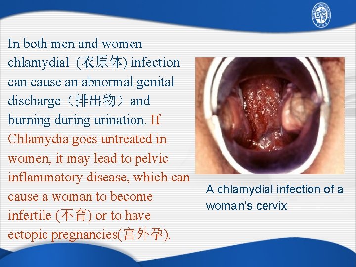 In both men and women chlamydial (衣原体) infection cause an abnormal genital discharge（排出物）and burning