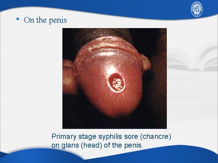  • On the penis Primary stage syphilis sore (chancre) on glans (head) of