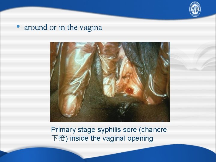  • around or in the vagina Primary stage syphilis sore (chancre 下疳) inside