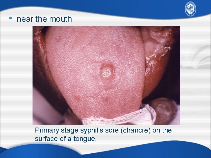  • near the mouth Primary stage syphilis sore (chancre) on the surface of