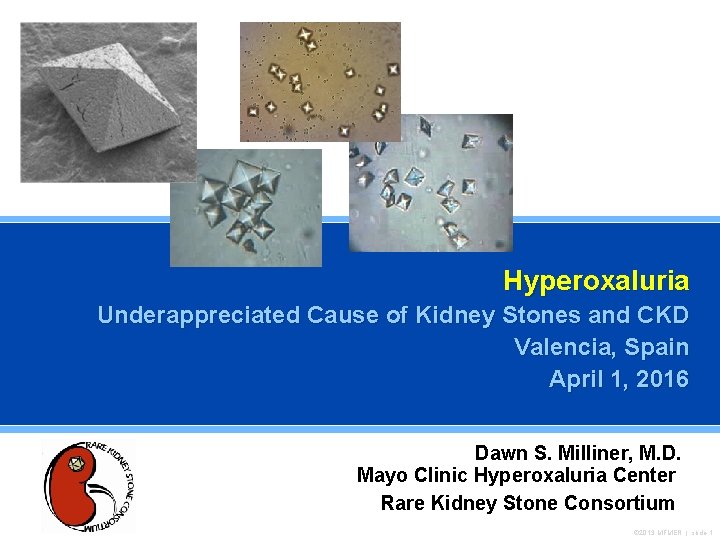 Hyperoxaluria Underappreciated Cause of Kidney Stones and CKD Valencia, Spain April 1, 2016 Dawn