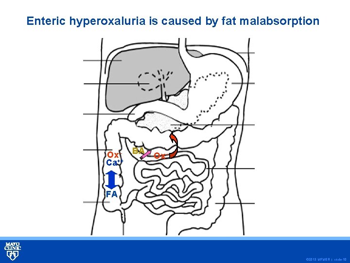 Enteric hyperoxaluria is caused by fat malabsorption Ox-- BA Ox-Ca++ FA © 2013 MFMER