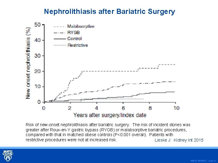 Nephrolithiasis after Bariatric Surgery Risk of new-onset nephrolithiasis after bariatric surgery. The risk of