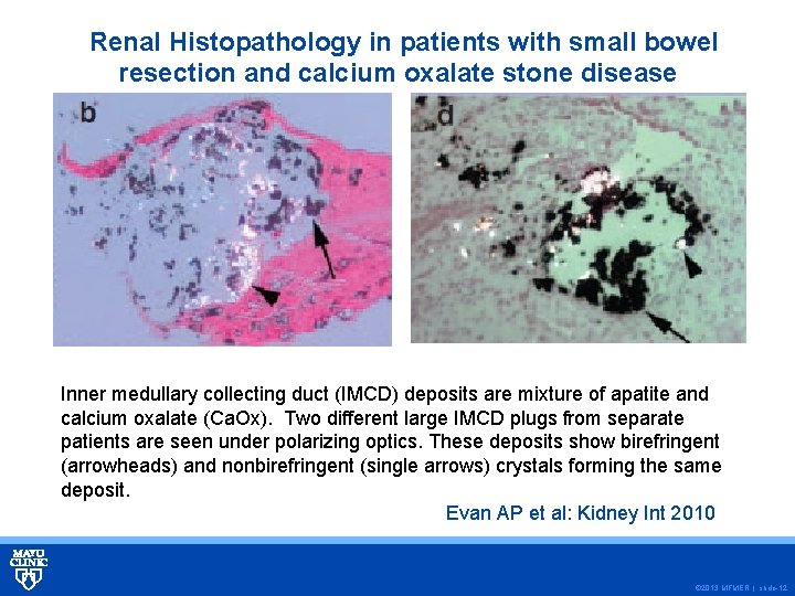 Renal Histopathology in patients with small bowel resection and calcium oxalate stone disease Inner