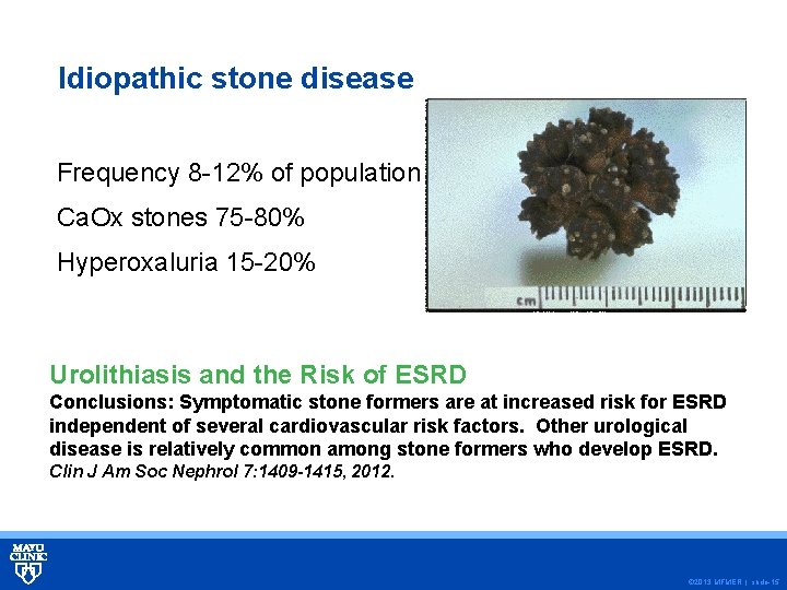 Idiopathic stone disease Frequency 8 -12% of population Ca. Ox stones 75 -80% Hyperoxaluria