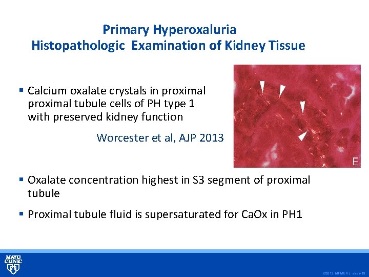 Primary Hyperoxaluria Histopathologic Examination of Kidney Tissue § Calcium oxalate crystals in proximal tubule