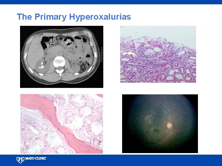 The Primary Hyperoxalurias 