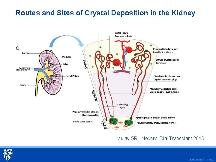 Routes and Sites of Crystal Deposition in the Kidney Mulay SR. Nephrol Dial Transplant