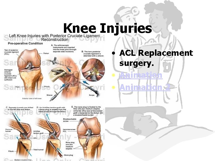 Knee Injuries • ACL Replacement surgery. • Animation 2 