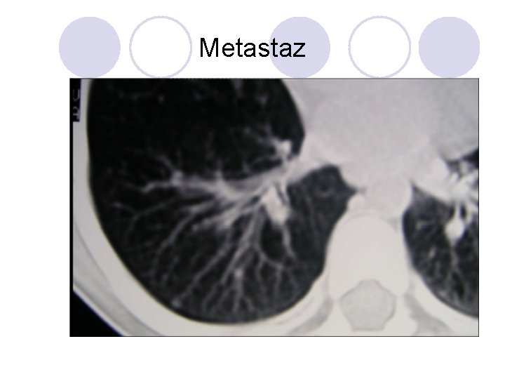 Metastaz Metastaz