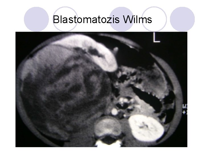 Blastomatozis Wilms Blastomatozis Wilms