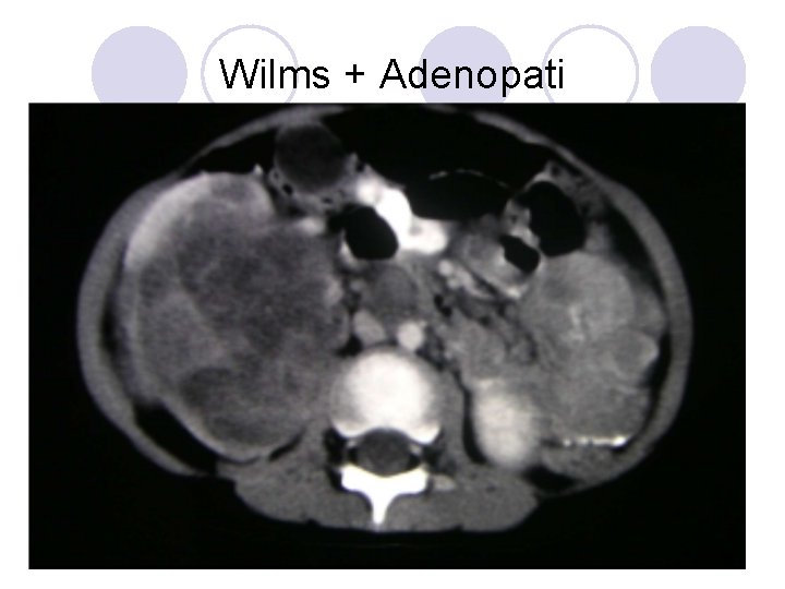 Wilms + Adenopati Wilms + Adenopati